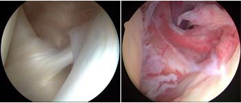 These photos taken through an arthroscope show a normal shoulder joint lining and an inflamed joint lining damaged by frozen shoulder.