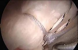 The tendon has been re-attached to the humeral head with sutures.