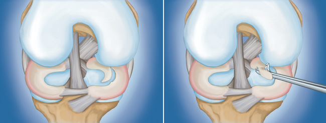 (Left) A large meniscal tear called a "flap" tear. (Right) Arthroscopic removal of the damaged meniscal tissue.